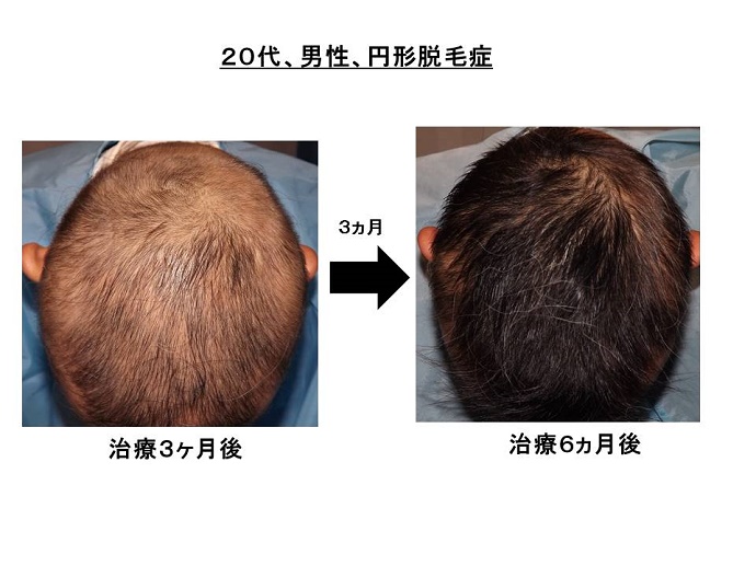 円形脱毛症　病院""